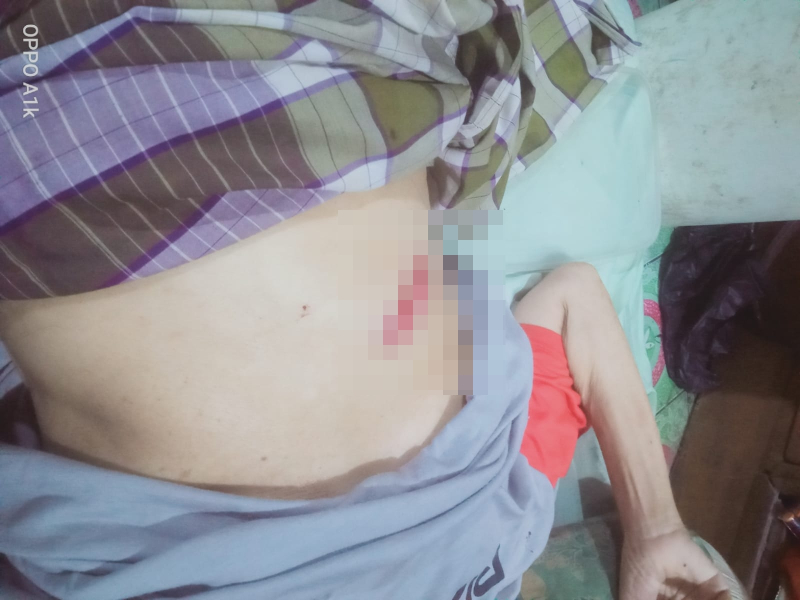 Tak Ada Biaya! Luka Operasi Terbuka, Warga Simpang Rimbo Ini Hanya Bisa Menahan Sakit di Rumah